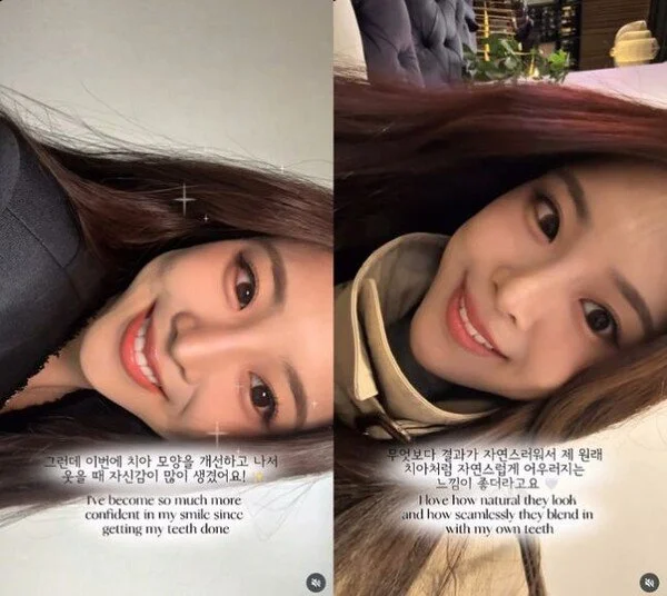 Miss Korea winner Woo Seo-yoon reveals dental correction and whitening results