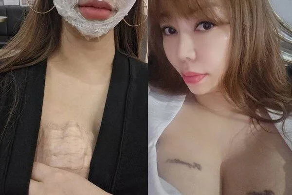 'I Am SOLO' star Choi Myeong-eun undergoes 7th laser session to remove chest tattoo